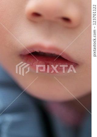 3歲女孩嘴唇乾裂 123701122