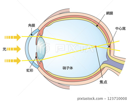 Illustrated illustration of axial myopia 123710008