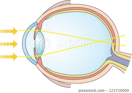 Illustrated illustration of axial myopia 123710009