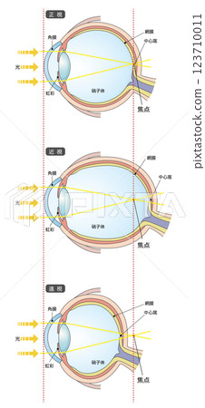以正常眼球和眼軸長度為依據的近視與遠視的比較 123710011