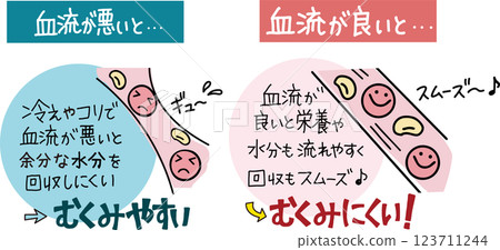 Illustrations and handwritten text that clearly explain the state of blood vessels and the likelihood of swelling when blood flow is good and bad 123711244