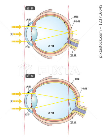 正常眼和軸性近視眼 正常眼和軸性近視眼 123716045