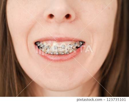 white female teeth in braces to correct bite, close-up. white female teeth in braces to correct bite, close-up. 123735101