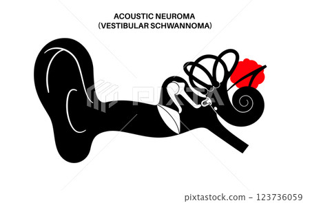 Acoustic neuroma poster 123736059