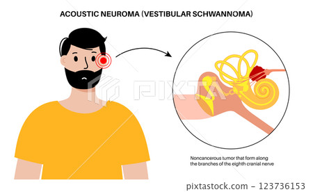 Acoustic neuroma poster 123736153
