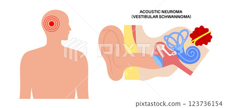 Acoustic neuroma poster 123736154