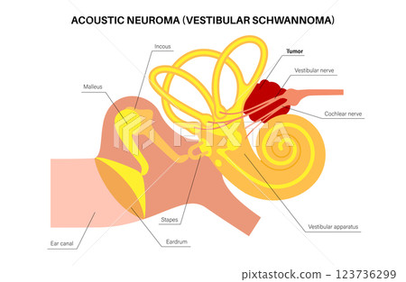 Acoustic neuroma poster 123736299
