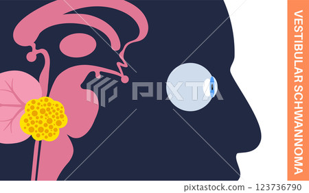Acoustic neuroma poster 123736790
