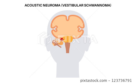 Acoustic neuroma poster 123736791
