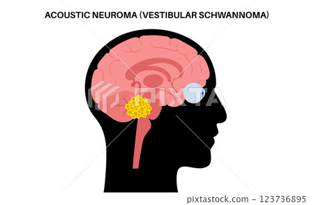 Acoustic neuroma poster 123736895