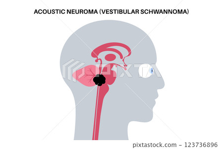 Acoustic neuroma poster 123736896