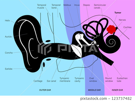 Acoustic neuroma poster 123737482