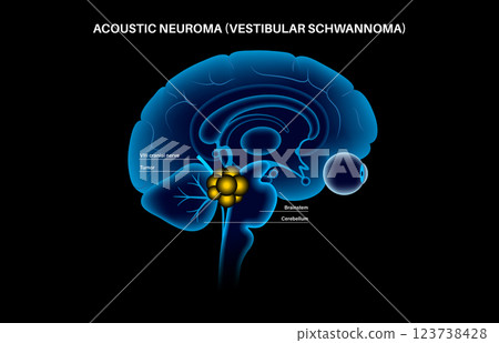 Acoustic neuroma poster 123738428