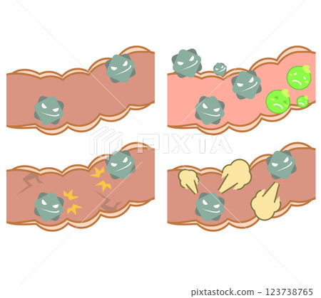 Illustration set of the large intestine with predominantly bad bacteria 123738765