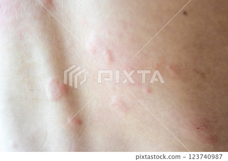 Young asian man itching and scratching on his back from allergic itchy dry skin eczema dermatitis insect bites Young asian man itching and scratching on his back from allergic itchy dry skin eczema dermatitis insect bites 123740987