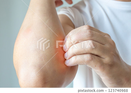 Young asian man itching and scratching on arm from allergic itchy dry skin eczema dermatitis insect bites Young asian man itching and scratching on arm from allergic itchy dry skin eczema dermatitis insect bites 123740988