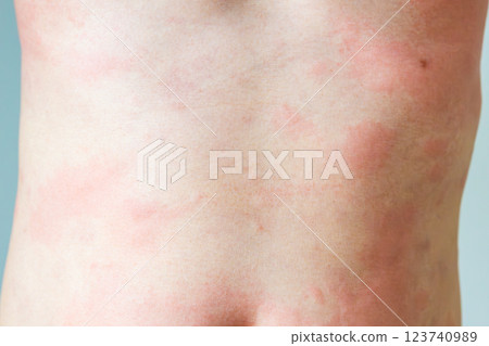 Young asian man itching and scratching on his back from allergic itchy dry skin eczema dermatitis insect bites Young asian man itching and scratching on his back from allergic itchy dry skin eczema dermatitis insect bites 123740989