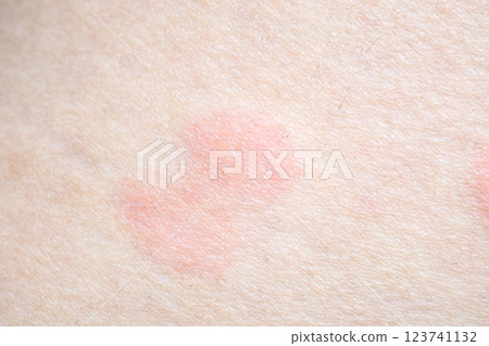 Skin allergy rash dermatitis texture close up 123741132