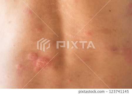 Young asian man itching and scratching on his back from allergic itchy dry skin eczema dermatitis insect bites 123741145