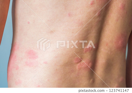 Young asian man itching and scratching on his back from allergic itchy dry skin eczema dermatitis insect bites 123741147