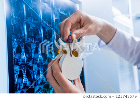 Doctor show polyaxial screw on the spine model. Spine fixation systems 123745579