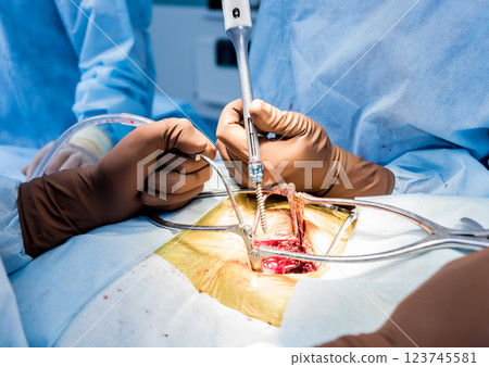 Spinal surgery. Surgeon tightens the polyaxial screw into the patient's spine. Spinal surgery. Surgeon tightens the polyaxial screw into the patient's spine. 123745581