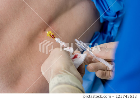 Epidural anesthesia injections. Prepare for surgery. Medical Epidural anesthesia injections. Prepare for surgery. Medical 123745618