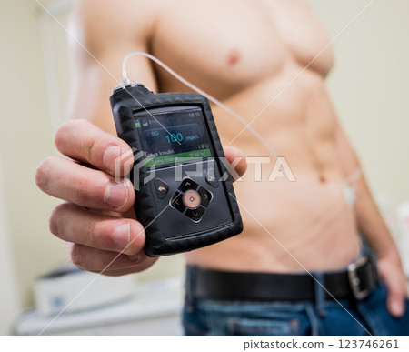 Diabetic man with an insulin pump connected in his abdomen and keeping the insulin pump 123746261