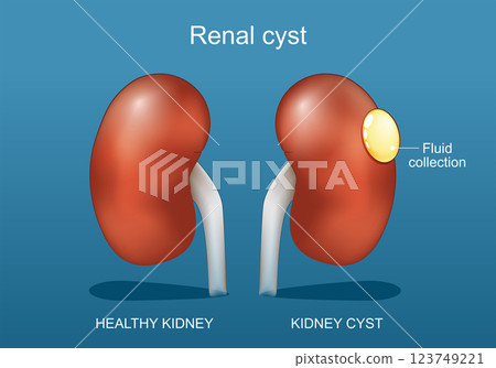 Renal cyst. human kidneys 123749221