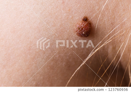 Closeup brown mole on caucasian woman skin. 123760936