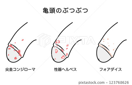 Bumps on male genitals - types of sexually transmitted diseases 123768626