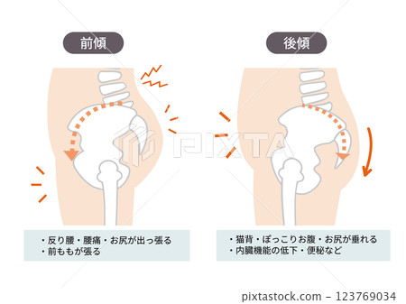 An illustrated illustration of the side of the body showing the position and symptoms of a distorted pelvis An illustrated illustration of the side of the body showing the position and symptoms of a distorted pelvis 123769034