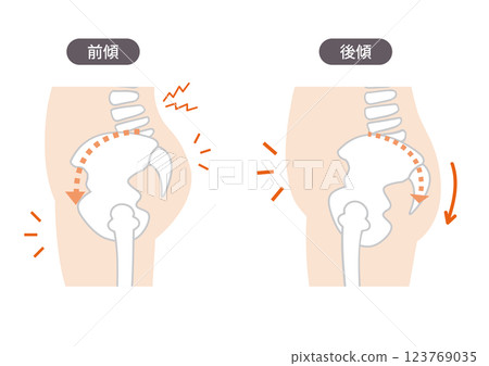 身體側面的插圖顯示了骨盆扭曲的位置和症狀 123769035