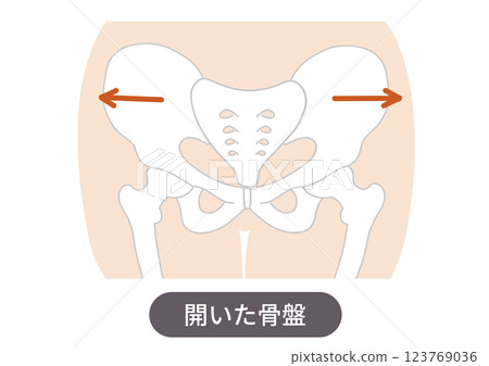 Illustrated illustration showing the position and condition of a distorted pelvis Illustrated illustration showing the position and condition of a distorted pelvis 123769036