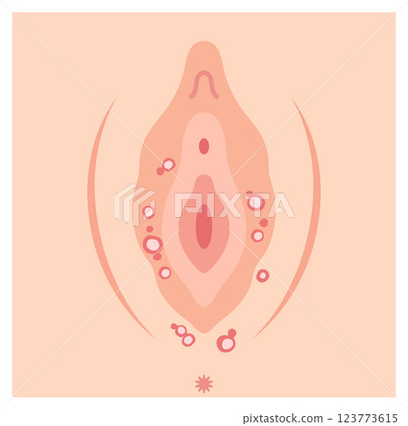 Diseases of the female external genitalia: Genital herpes Diseases of the female external genitalia: Genital herpes 123773615