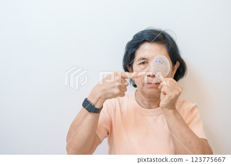 Elderly Woman with eye protective shield after eye surgery. Eye disease, Cataract, Glaucoma, Age Related Macular Degeneration, Diabetic Retinopathy, Vitreous, Lasik, World Glaucoma day and health Elderly Woman with eye protective shield after eye surgery. Eye disease, Cataract, Glaucoma, Age Related Macular Degeneration, Diabetic Retinopathy, Vitreous, Lasik, World Glaucoma day and health 123775667