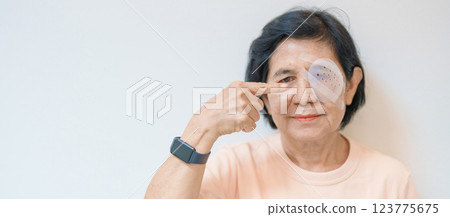 Elderly Woman with eye protective shield after eye surgery. Eye disease, Cataract,  Glaucoma, Age Related Macular Degeneration, Diabetic Retinopathy, Vitreous, Lasik, World Glaucoma day and health 123775675