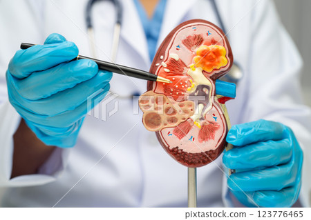 Chronic kidney disease, doctor with model for treatment urinary system, urology, Estimated glomerular filtration rate eGFR. Chronic kidney disease, doctor with model for treatment urinary system, urology, Estimated glomerular filtration rate eGFR. 123776465