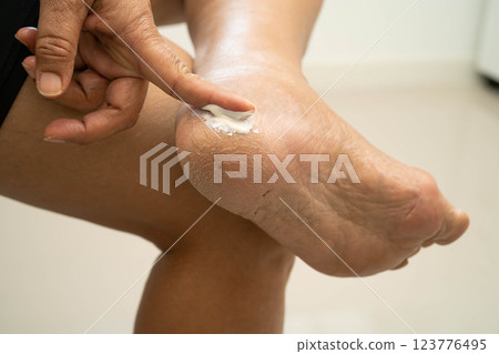 Asian woman applying moisturizing cream skincare treatment to solve and repair feet with crack and dry heel skin. Asian woman applying moisturizing cream skincare treatment to solve and repair feet with crack and dry heel skin. 123776495