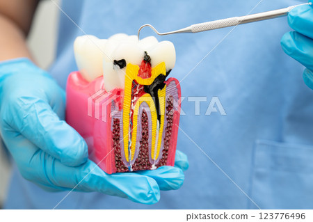 Teeth root dental model with tool for dentist use to cleaning care treatment. 123776496