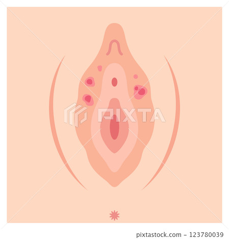 Diseases of the female external genitalia: Syphilis 123780039