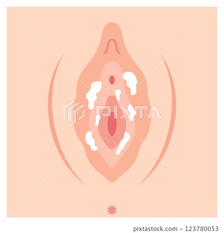 Diseases of the female external genitalia: Candidiasis 123780053