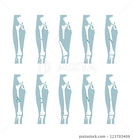Types of bone fractures medical educational vector 123783409