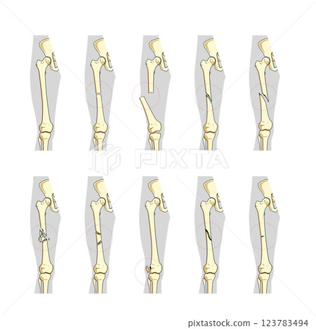 Types of bone fractures medical educational vector Types of bone fractures medical educational vector 123783494