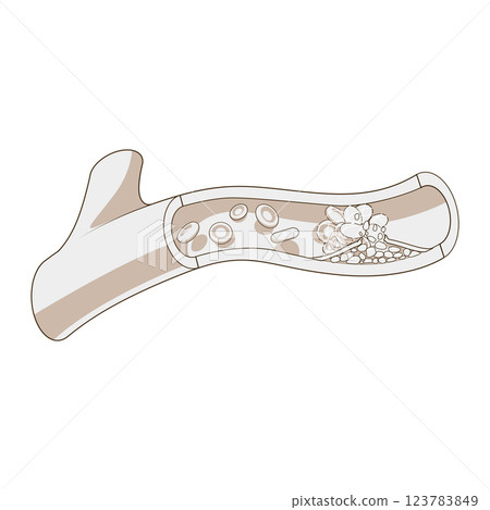 Blood vessel and clot thrombus vector illustration 123783849