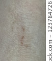 Wound healing scab close-up 123784726