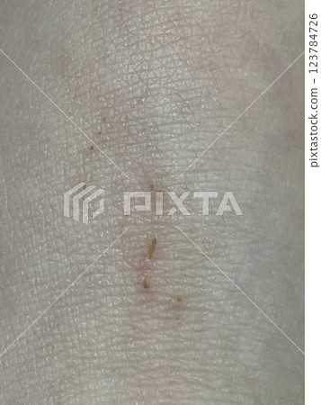 傷口癒合結痂特寫 123784726