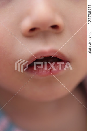 3歲女孩嘴唇乾裂 123786951