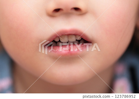 3-year-old girl with chapped lips 3-year-old girl with chapped lips 123786952