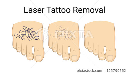 Laser Tattoo Removal Procedure on foot Laser Tattoo Removal Procedure on foot 123799562